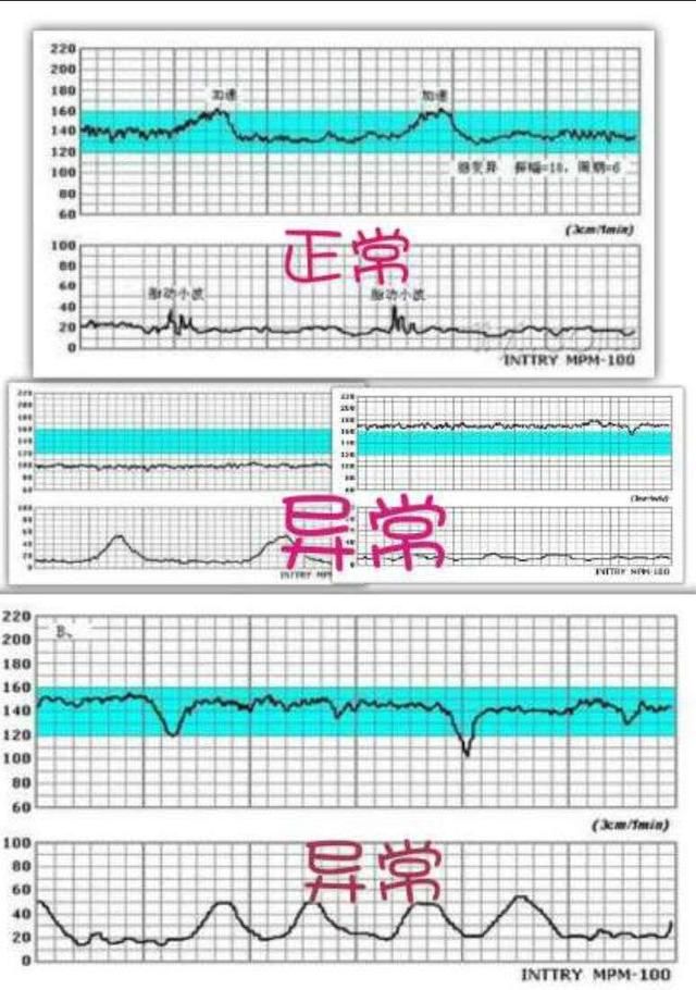 五个月胎心率的解读，胎心160次/分钟是正常的吗？